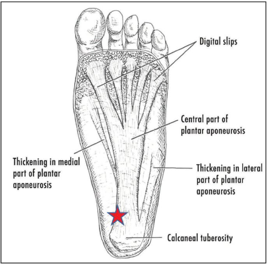 How do you know if you have plantar fasciitis? Four telltale signs